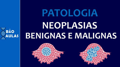 Neoplasias Benignas e Malignas - Características, Nomenclatura e Diferenciação (Patologia Geral)