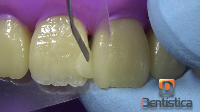 Restauração de dente anterior fraturado